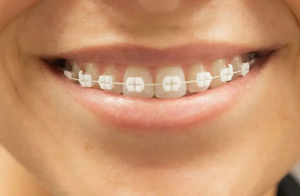 Whole health orthodontics is the best orthodontic approach only offered at Orthospaceship in LA