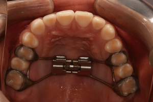 Upper arch with palatal expander-Kendrick Orthodontics,Kissimmee FL