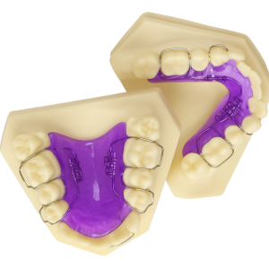 Upper and lower jaw models with orthodontic expanders.