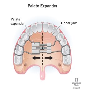 Palatal expander used in early orthodontic treatment to help guide upper jaw growth.