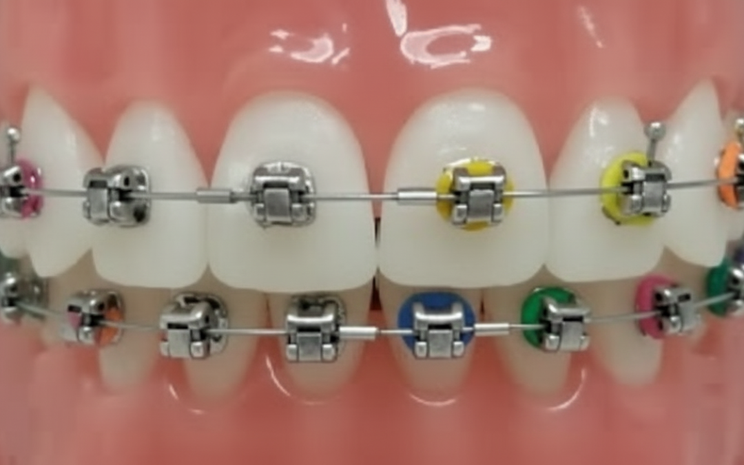 Damon Braces  Kissimmee, FL-Modern Self-Ligating System