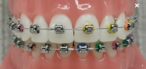 Damon braces Kissimmee- Dr. James Kendrick