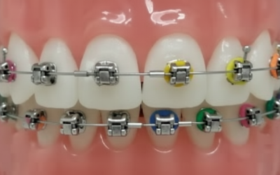 Damon Braces  Kissimmee, FL-Modern Self-Ligating System