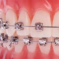 Pitts 21 self-ligating braces-low-profile bracets