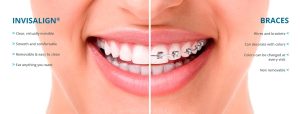 invisalign vs braces