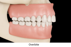 Close-up of teeth showing an overbite before orthodontic treatment.