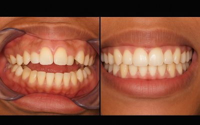 Adult Open Bite — Causes, Treatment & Results in Kissimmee, FL