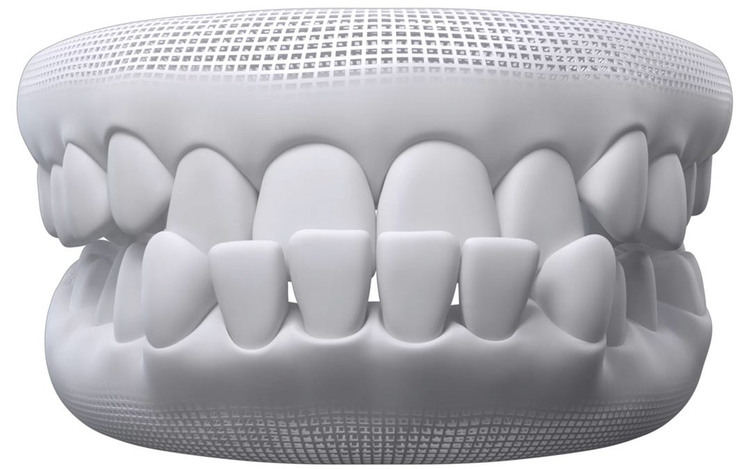 What Is an Underbite?