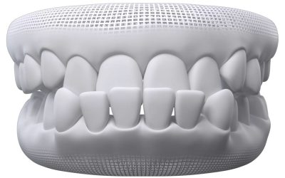 What Is an Underbite?